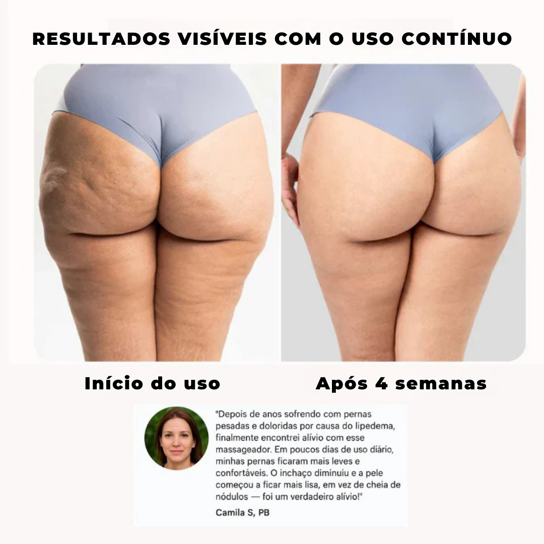 Bountys® Drena Roller – Massageador Linfático para Lipedema e Celulite